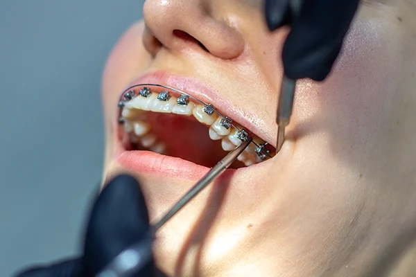 braces braces